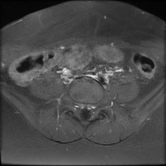 File:Bilateral ovarian fibrothecomas - adolescent (Radiopaedia 86604-102707 Axial T1 C+ fat sat 3).jpg