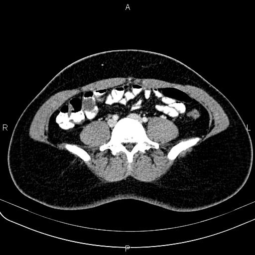 Bilateral ovarian teratoma (Radiopaedia 83131-97503 Axial With contrast 4).jpg