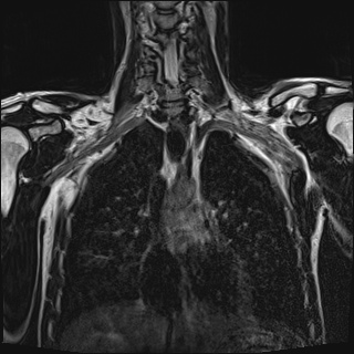 File:Bilateral spinoglenoid notch ganglion cysts (Radiopaedia 29577-30082 Coronal T2 54).jpg