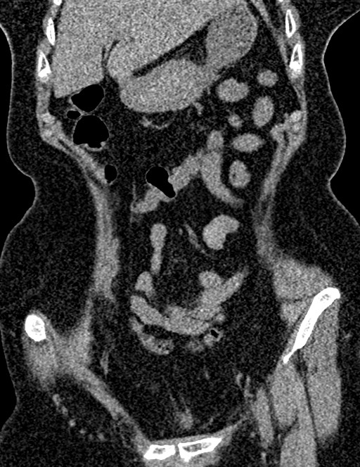 Bilateral staghorn calculi (Radiopaedia 59475-66842 Coronal non-contrast 43).jpg