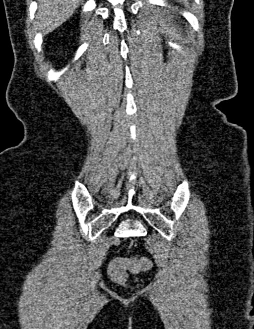 Bilateral staghorn calculi (Radiopaedia 59475-66842 Coronal non-contrast 85).jpg