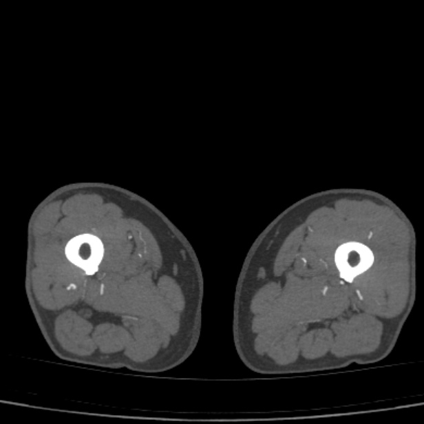 Bilateral superficial femoral arterial occlusion (Radiopaedia 25682-25857 A 43).jpg