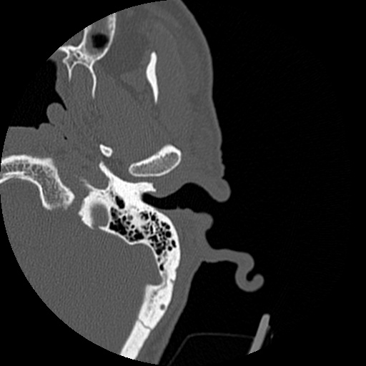 Bilateral temporal bone fractures (Radiopaedia 29482-29970 D 40).jpg
