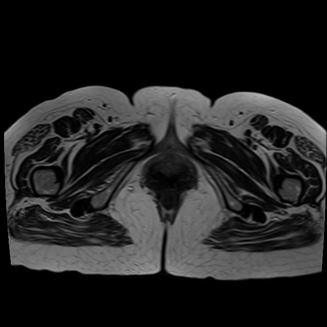 Bilateral tubo-ovarian abscesses (Radiopaedia 58635-65829 Axial T2 48).jpg
