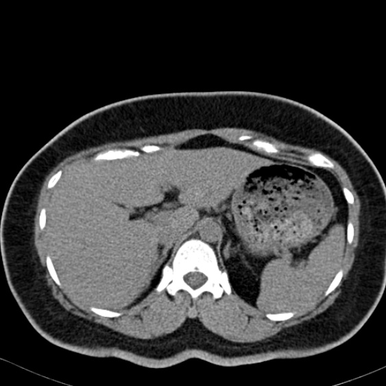 Bilateral ureteric stents (Radiopaedia 48795-53825 Axial non-contrast 11).jpg