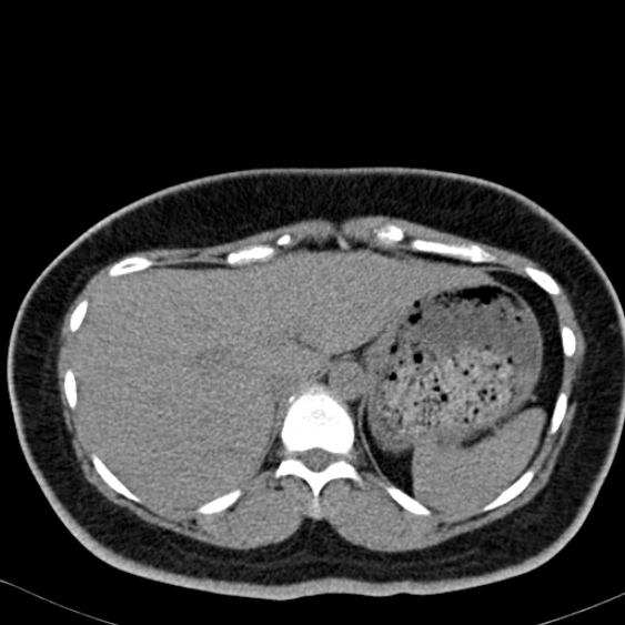 Bilateral ureteric stents (Radiopaedia 48795-53825 Axial non-contrast 7).jpg