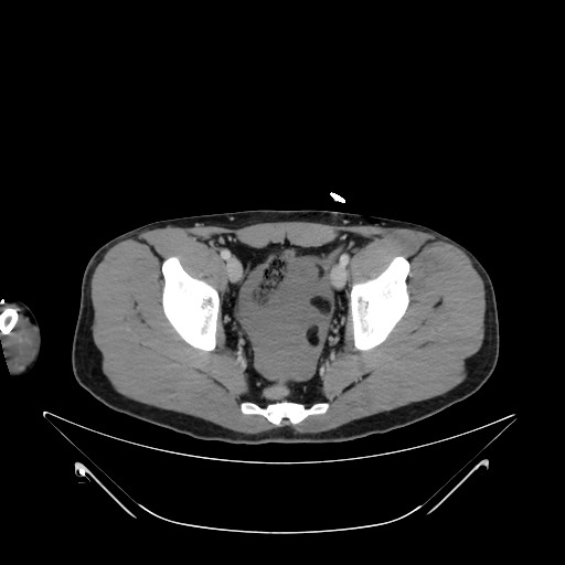 Bile leak from liver traumatic laceration (Radiopaedia 63463-72078 A 73).jpg