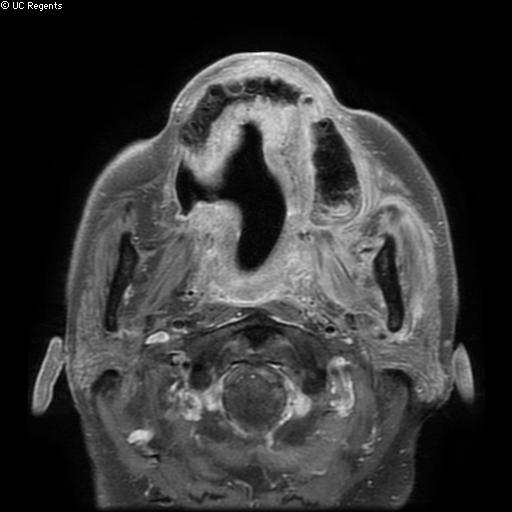 Bisphosphonate-related osteonecrosis of the maxilla (Radiopaedia 51367-57101 Axial T1 C+ fat sat 18).jpg