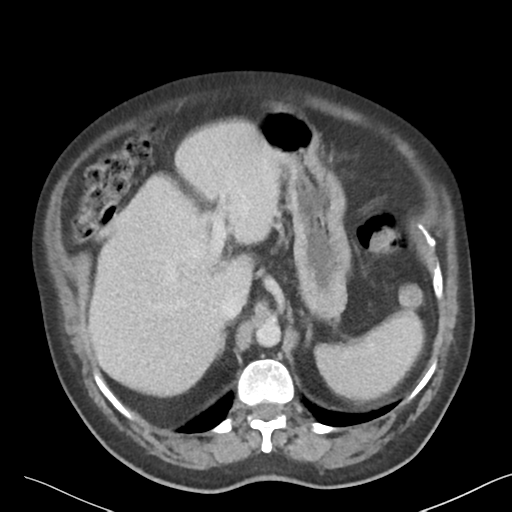 File:Bladder papillary urothelial carcinoma (Radiopaedia 48119-52951 Axial 10).png