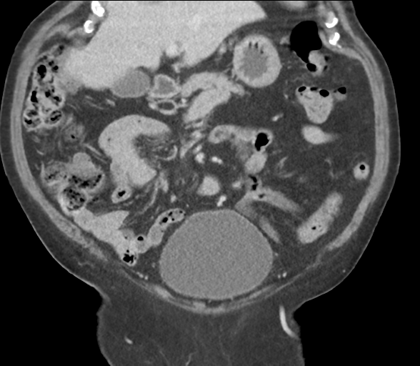 File:Bladder papillary urothelial carcinoma (Radiopaedia 48119-52951 C 26).png