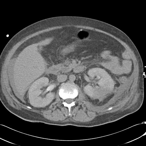 Bladder rupture post renal biopsy (Radiopaedia 30863-31572 Axial non-contrast 37).jpg