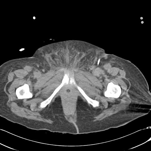 Bladder rupture post renal biopsy (Radiopaedia 30863-31572 Axial non-contrast 92).jpg
