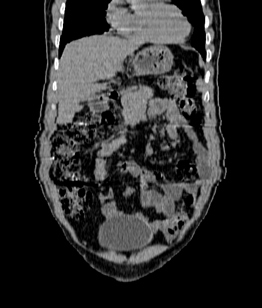 Bladder schistosomiasis (Radiopaedia 70913-81121 Coronal non-contrast 2).jpg