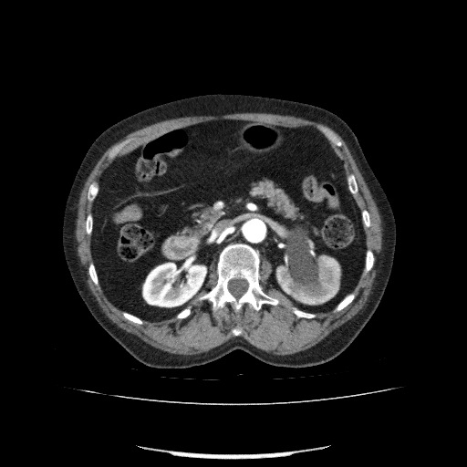 Bladder tumor detected on trauma CT (Radiopaedia 51809-57609 A 101).jpg