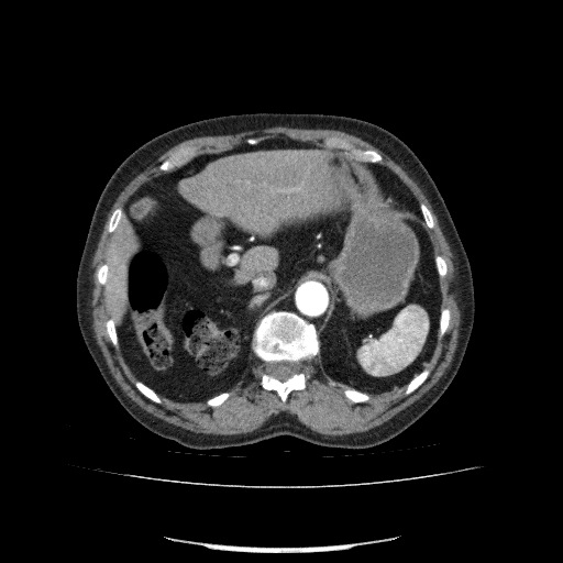 Bladder tumor detected on trauma CT (Radiopaedia 51809-57609 A 86).jpg