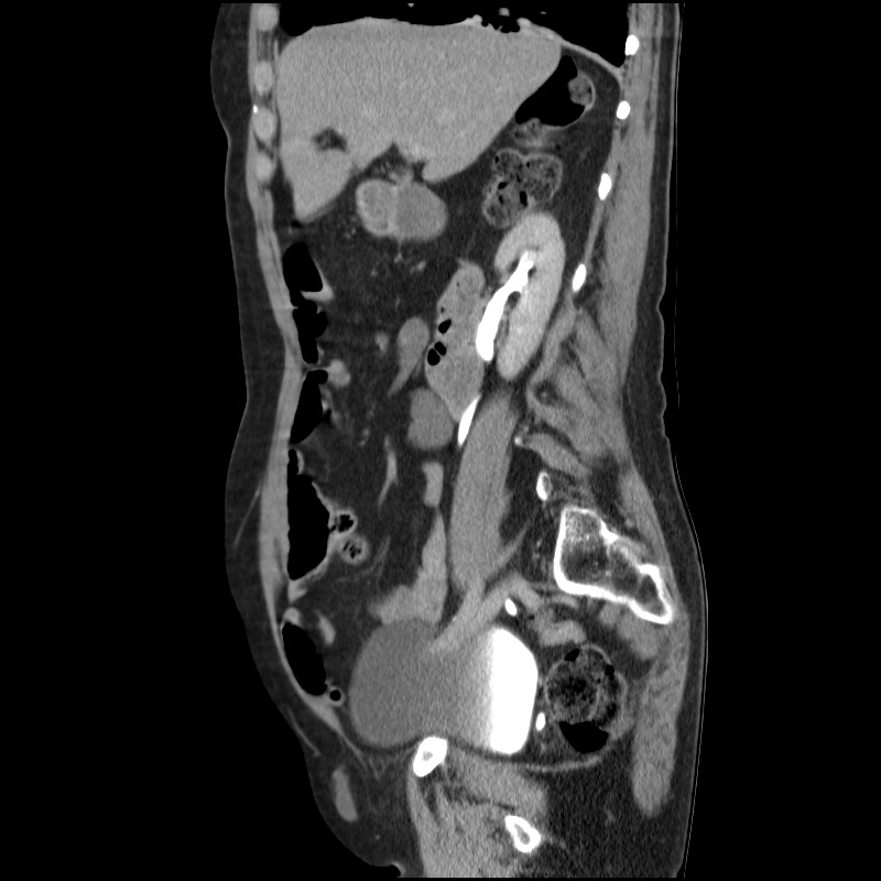 Bladder tumor detected on trauma CT (Radiopaedia 51809-57609 E 49).jpg