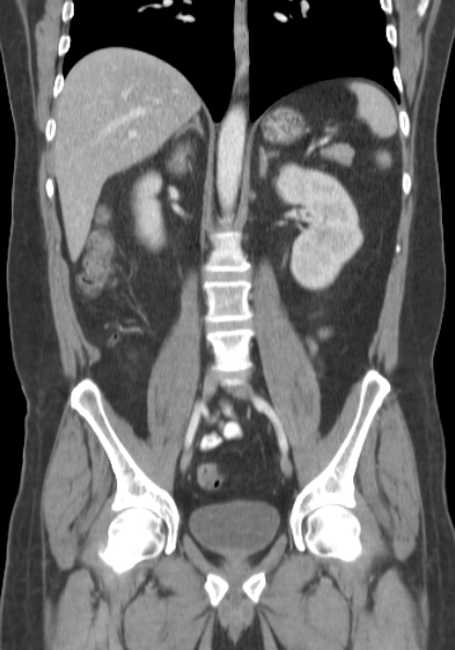Bleeding duodenal ulcer and adenomyomatosis of gallbladder (Radiopaedia 61834-69861 B 37).jpg