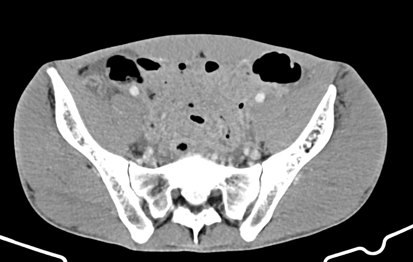 Blunt injury to the small bowel (Radiopaedia 74953-85987 A 152).jpg