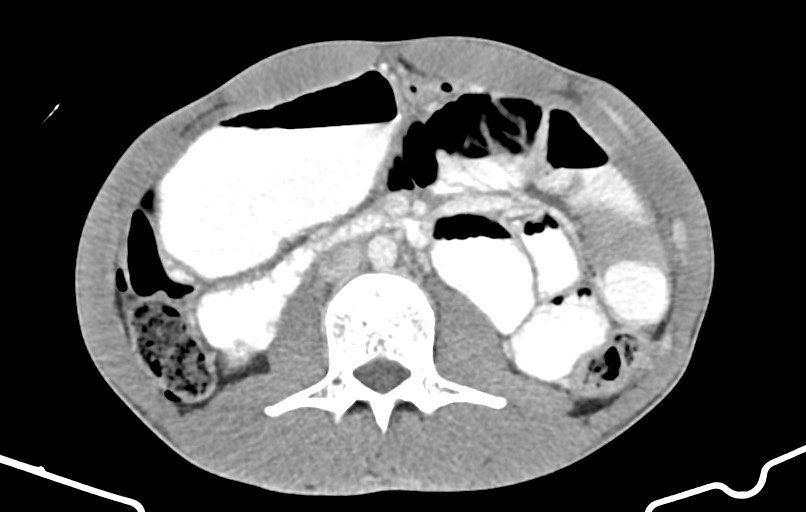 Blunt injury to the small bowel (Radiopaedia 74953-85987 A 80).jpg