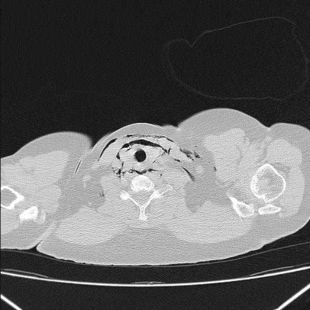 Boerhaave syndrome (Radiopaedia 45644-49799 Axial lung window 19).jpg