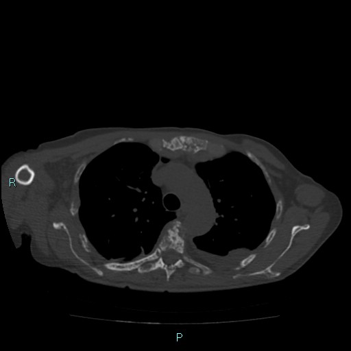 File:Bone metastases from untreated breast cancer (Radiopaedia 42973-46219 Axial bone window 32).jpg