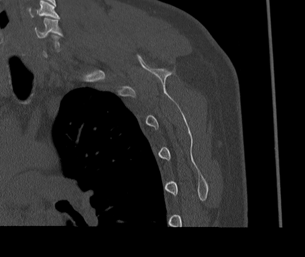 Bony Bankart and Hill-Sachs lesions (Radiopaedia 33622-34727 Sagittal bone window 65).png