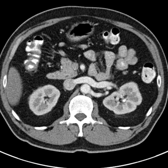 File:Bosniak cyst - type IV (Radiopaedia 23525-23627 renal cortical phase 18).jpg
