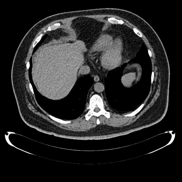Bosniak renal cyst - type IV (Radiopaedia 24244-24518 Axial non-contrast 37).jpg