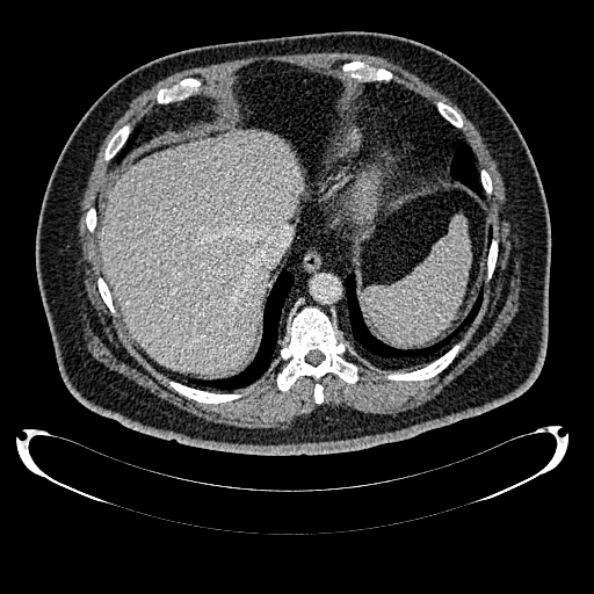 Bosniak renal cyst - type IV (Radiopaedia 24244-24518 C 30).jpg
