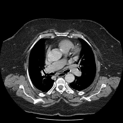 Bovine aortic arch - right internal mammary vein drains into the superior vena cava (Radiopaedia 63296-71875 A 65).jpg