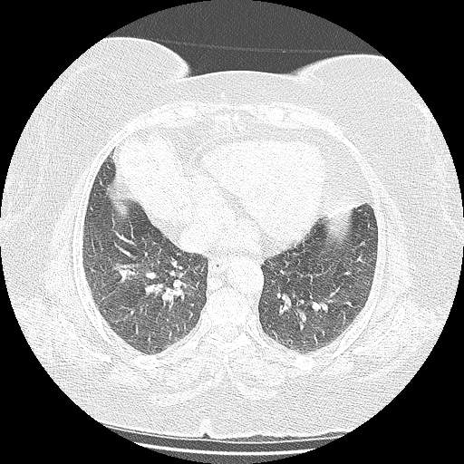 Bovine aortic arch - right internal mammary vein drains into the superior vena cava (Radiopaedia 63296-71875 Axial lung window 112).jpg
