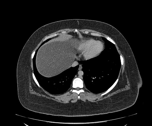 Bowel and splenic infarcts in acute lymphocytic leukemia (Radiopaedia 61055-68913 A 17).jpg