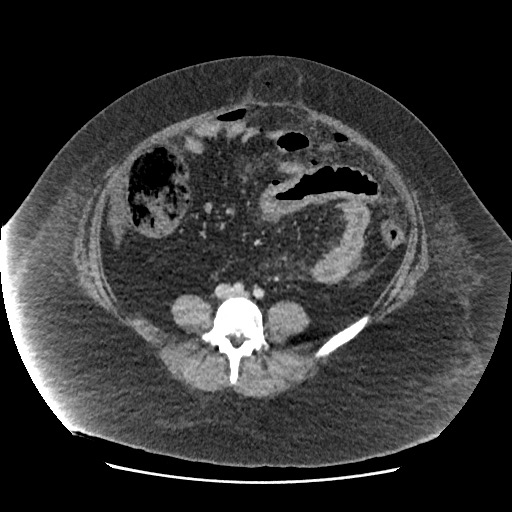 Bowel and splenic infarcts in acute lymphocytic leukemia (Radiopaedia 61055-68915 A 86).jpg