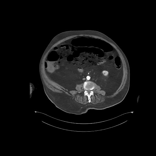 File:Bowel ischemia secondary to SMA occlusion with extensive portomesenteric venous gas (Radiopaedia 54656-60871 A 31).jpg