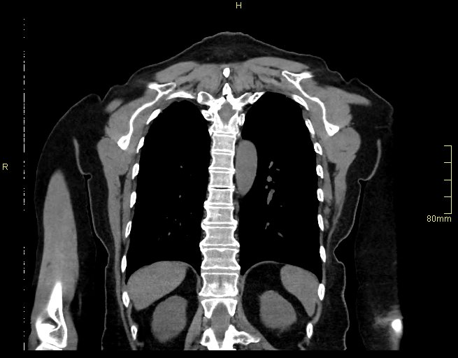 Brachial artery foreign body (Radiopaedia 54583-60820 Coronal non-contrast 45).jpg