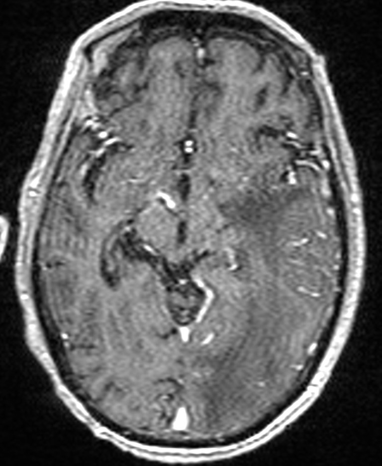Brain abscess with dual rim sign (Radiopaedia 87566-103938 Axial T1 C+ 76).jpg
