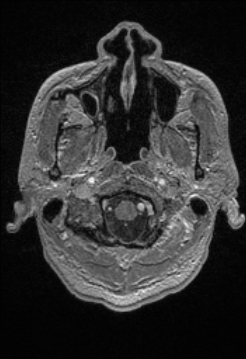 Brain abscess with ventriculitis (Radiopaedia 85703-101495 Axial T1 C+ 22).jpg