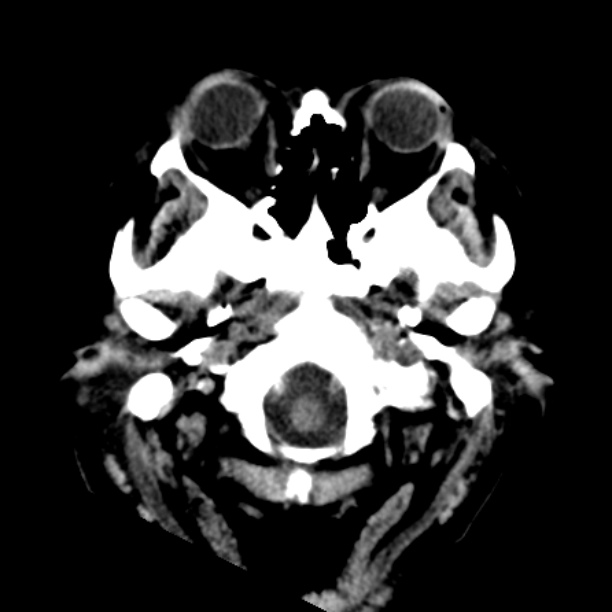 Brain cortical laminar necrosis (Radiopaedia 25822-25971 Axial non-contrast 2).jpg