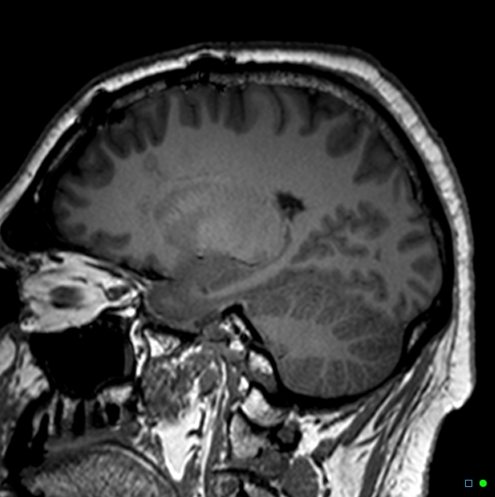 Brain death on MRI and CT angiography (Radiopaedia 42560-45689 Sagittal T1 45).jpg