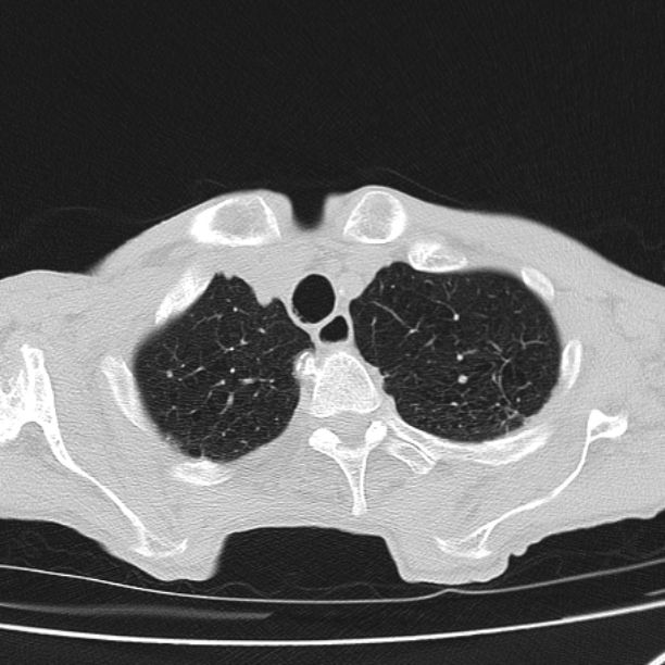 Brain metastases from lung cancer (Radiopaedia 27849-28093 Axial lung window 10).jpg
