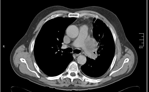 File:Brain metastases from squamocellular lung cancer (Radiopaedia 56515-63219 B 29).jpg