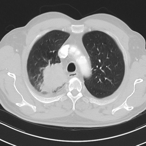 Brain metastasis (large cystic mass) (Radiopaedia 47497-52104 Axial lung window 11).png