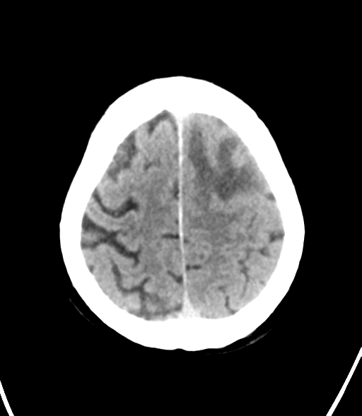 File:Brain metastasis (lung cancer) (Radiopaedia 48289-53177 Axial non-contrast 28).png