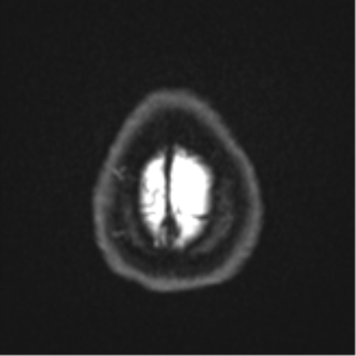 File:Brain metastasis (sarcoma) (Radiopaedia 47576-52209 Axial DWI 26).png