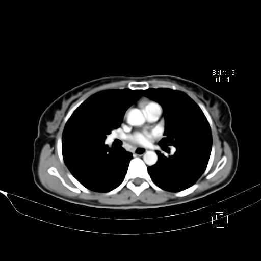 Brain metastasis as initial presentation of non-small cell lung cancer (Radiopaedia 65122-74127 A 24).jpg