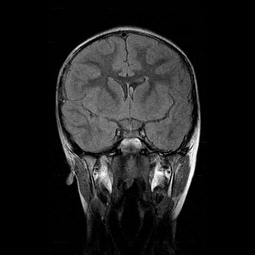 File:Brainstem ganglioglioma (Radiopaedia 10763-11224 Coronal FLAIR 12).jpg