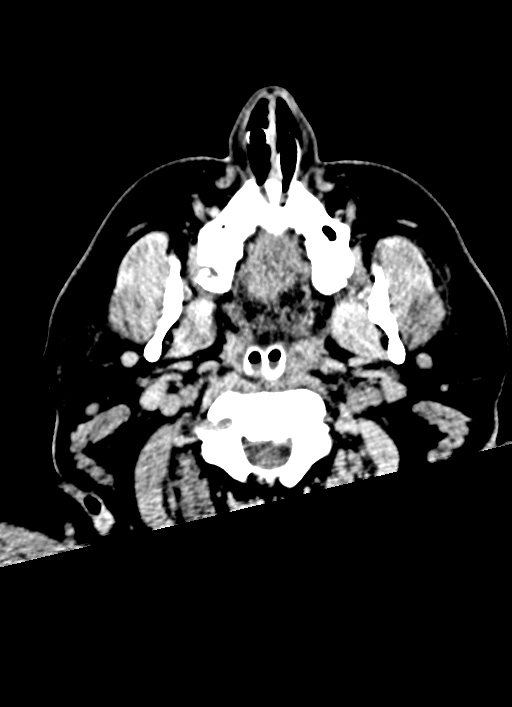Brainstem hemorrhage (Radiopaedia 81294-94976 Axial non-contrast 69).jpg