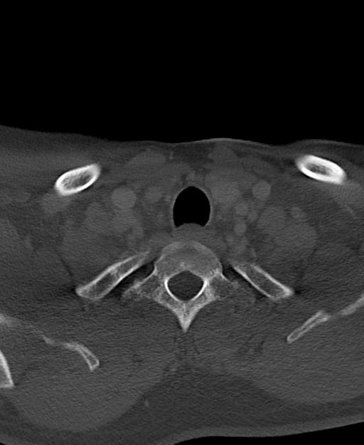 Branchial cleft cyst (Radiopaedia 31167-31875 Axial bone window 65).jpg