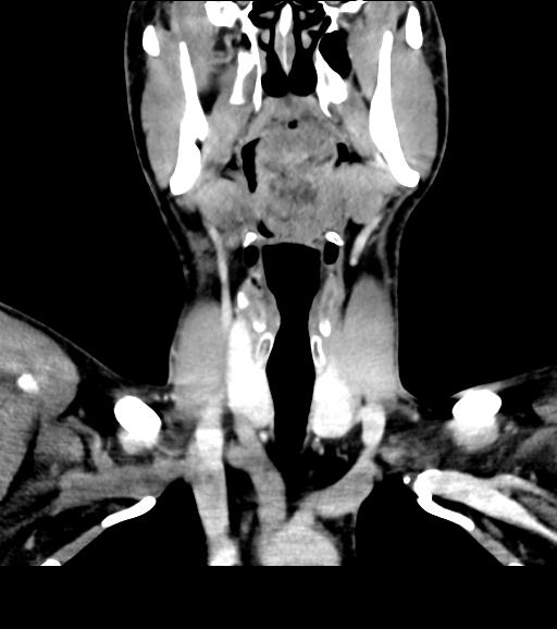 Branchial cleft cyst (Radiopaedia 31167-31875 Coronal C+ delayed 28).jpg