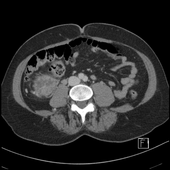 File:Breast metastases from renal cell cancer (Radiopaedia 79220-92225 C 63).jpg
